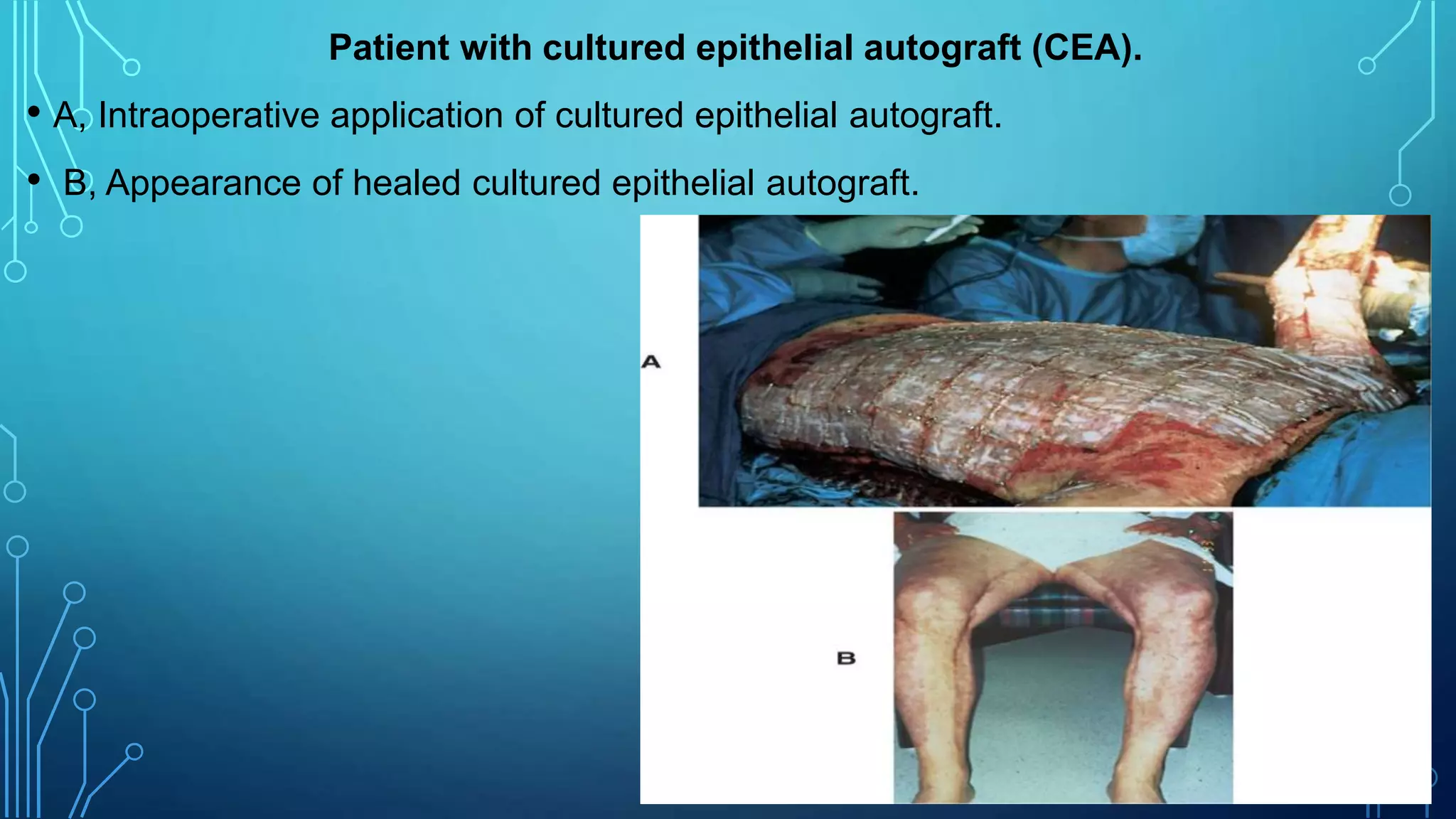 Patient with cultured epithelial autograft (CEA).
• A, Intraoperative application of cultured epithelial autograft.
• B, Appearance of healed cultured epithelial autograft.
 