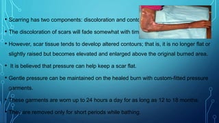 • Scarring has two components: discoloration and contour.
• The discoloration of scars will fade somewhat with time.
• However, scar tissue tends to develop altered contours; that is, it is no longer flat or
slightly raised but becomes elevated and enlarged above the original burned area.
• It is believed that pressure can help keep a scar flat.
• Gentle pressure can be maintained on the healed burn with custom-fitted pressure
garments.
• These garments are worn up to 24 hours a day for as long as 12 to 18 months.
• They are removed only for short periods while bathing.
 