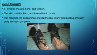Deep frostbite
• It involves muscle, bone, and tendon.
• The skin is white, hard, and insensitive to touch.
• The area has the appearance of deep thermal injury with mottling gradually
progressing to gangrene.
 