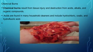 Chemical Burns
• Chemical burns result from tissue injury and destruction from acids, alkalis, and
organic compounds.
• Acids are found in many household cleaners and include hydrochloric, oxalic, and
hydrofluoric acid.
•
 