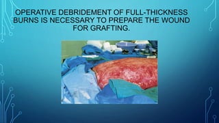 OPERATIVE DEBRIDEMENT OF FULL-THICKNESS
BURNS IS NECESSARY TO PREPARE THE WOUND
FOR GRAFTING.
 