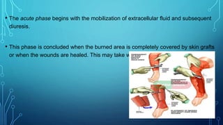 • The acute phase begins with the mobilization of extracellular fluid and subsequent
diuresis.
• This phase is concluded when the burned area is completely covered by skin grafts
or when the wounds are healed. This may take weeks or many months.
 