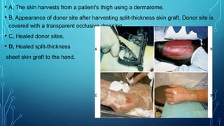 • A, The skin harvests from a patient's thigh using a dermatome.
• B, Appearance of donor site after harvesting split-thickness skin graft. Donor site is
covered with a transparent occlusive dressing.
• C, Healed donor sites.
• D, Healed split-thickness
sheet skin graft to the hand.
 