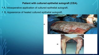 Patient with cultured epithelial autograft (CEA).
• A, Intraoperative application of cultured epithelial autograft.
• B, Appearance of healed cultured epithelial autograft.
 