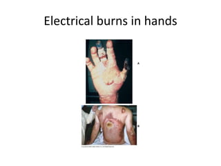 Electrical burns in hands
 