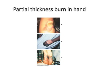 Partial thickness burn in hand
 