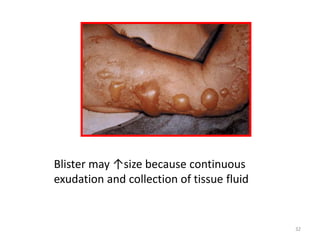 32
Blister may ↑size because continuous
exudation and collection of tissue fluid
 