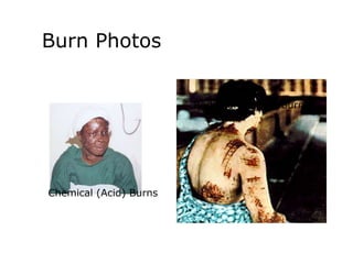 Burn Photos
Chemical (Acid) Burns
Radiation (Flash) Burns
 