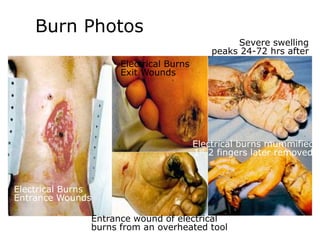 Burn Photos
Electrical Burns
Entrance Wounds
Electrical Burns
Exit Wounds
Entrance wound of electrical
burns from an overheated tool
Severe swelling
peaks 24-72 hrs after
Electrical burns mummified
1st 2 fingers later removed
 