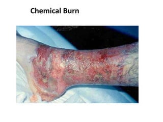 Chemical Burn
 