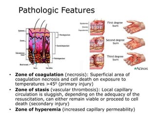 Pathologic Features
• Zone of coagulation (necrosis): Superficial area of
coagulation necrosis and cell death on exposure to
temperatures >450 (primary injury)
• Zone of stasis (vascular thrombosis): Local capillary
circulation is sluggish, depending on the adequacy of the
resuscitation, can either remain viable or proceed to cell
death (secondary injury)
• Zone of hyperemia (increased capillary permeability)
 
