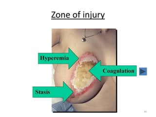 Zone of injury
40
 