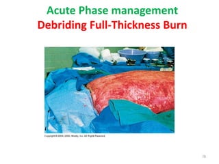 Acute Phase management
Debriding Full-Thickness Burn
78
 