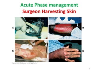 Acute Phase management
Surgeon Harvesting Skin
79
 