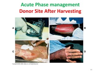Acute Phase management
Donor Site After Harvesting
80
 