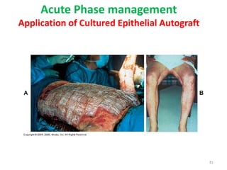 Acute Phase management
Application of Cultured Epithelial Autograft
81
 