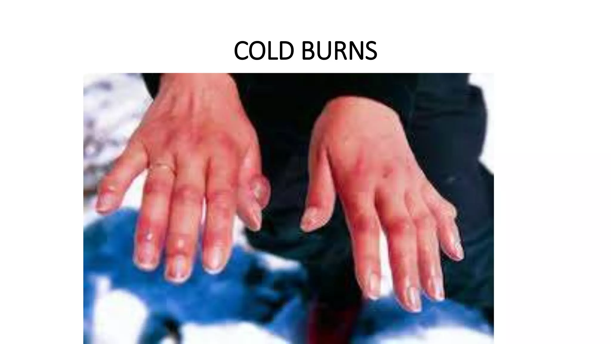 Burns | PPTX