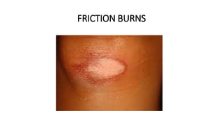 Friction Burn Def Burns | PPTX