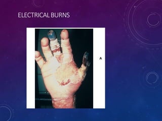 ELECTRICALBURNS
 