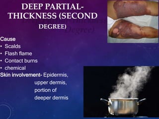 DEEP PARTIAL-
THICKNESS (SECOND
DEGREE)
Cause
• Scalds
• Flash flame
• Contact burns
• chemical
Skin involvement- Epidermis,
upper dermis,
portion of
deeper dermis
 