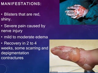MANIFESTATIONS:
• Blisters that are red,
shiny.
• Severe pain caused by
nerve injury
• mild to moderate edema
• Recovery in 2 to 4
weeks, some scarring and
depigmentation
contractures
 