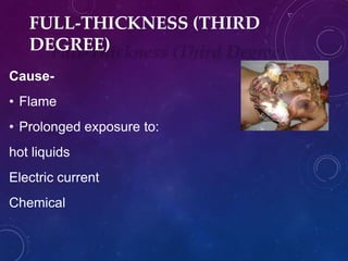 FULL-THICKNESS (THIRD
DEGREE)
Cause-
• Flame
• Prolonged exposure to:
hot liquids
Electric current
Chemical
 