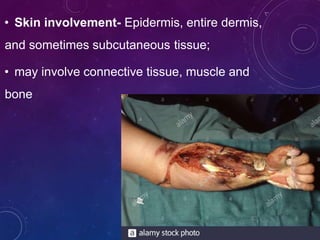• Skin involvement- Epidermis, entire dermis,
and sometimes subcutaneous tissue;
• may involve connective tissue, muscle and
bone
 