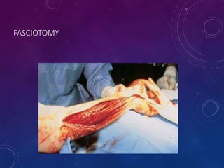 FASCIOTOMY
 
