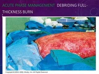 ACUTE PHASE MANAGEMENT DEBRIDING FULL-
THICKNESS BURN
7
0
 
