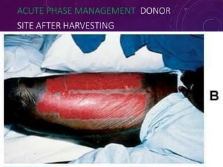 ACUTE PHASE MANAGEMENT DONOR
SITE AFTER HARVESTING
7
2
 