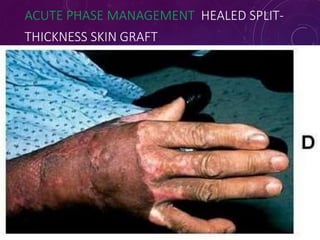 ACUTE PHASE MANAGEMENT HEALED SPLIT-
THICKNESS SKIN GRAFT
7
3
 