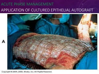 ACUTE PHASE MANAGEMENT
APPLICATION OF CULTURED EPITHELIAL AUTOGRAFT
7
4
 
