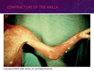 CONTRACTURE OF THE AXILLA
7
6
 