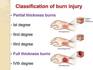 Burns and its management | PPTX