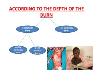 Burns in children