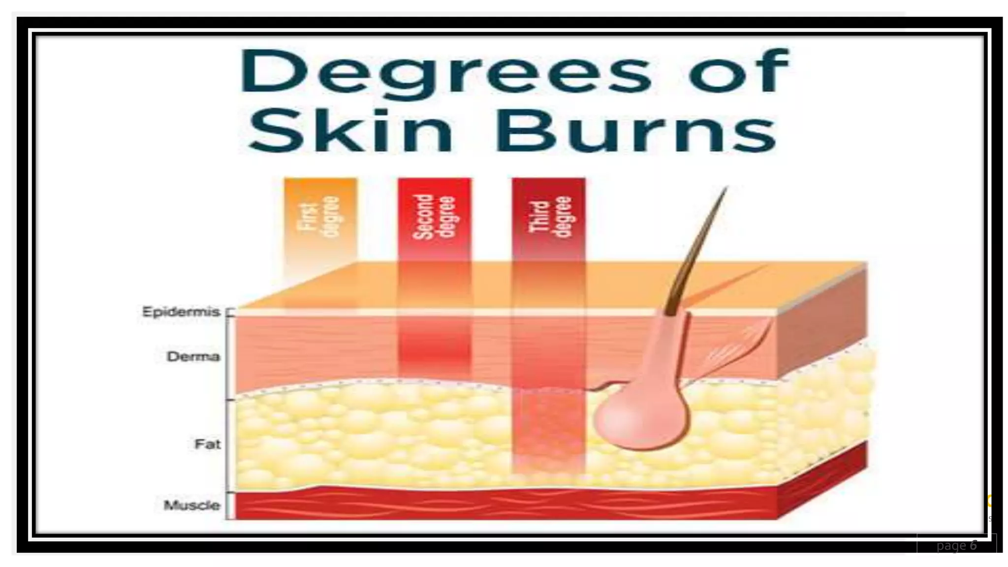 Burn burn to human body | PPT