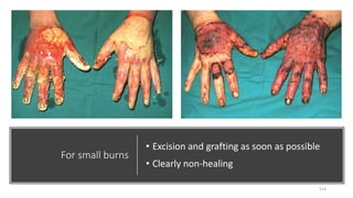 For small burns
• Excision and grafting as soon as possible
• Clearly non-healing
114
 