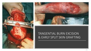 TANGENTIAL BURN EXCISION
& EARLY SPLIT SKIN GRAFTING
116
 