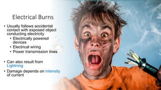 Electrical Burns
• Usually follows accidental
contact with exposed object
conducting electricity
• Electrically powered
devices
• Electrical wiring
• Power transmission lines
• Can also result from
Lightning
• Damage depends on intensity
of current
15
 