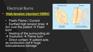Electrical Burns
• High-tension injuries(>1000V)
• Flash/ Flame / Current
• Earthed high tension lines 
Arc over the patient  Flash
burn
• Heating of the surrounding air
 Explosion  Flame burn
• Direct contact  patient acts
as conduction rod huge
subcutaneous damage
 