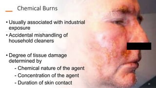 Chemical Burns
• Usually associated with industrial
exposure
• Accidental mishandling of
household cleaners
• Degree of tissue damage
determined by
- Chemical nature of the agent
- Concentration of the agent
- Duration of skin contact 23
 