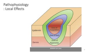 Pathophysiology
: Local Effects
33
JACKSON’s burn zones
 