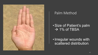 Palm Method
•Size of Patient’s palm
 1% of TBSA
•Irregular wounds with
scattered distribution.
 