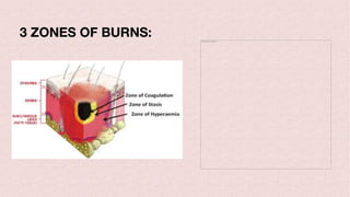 The picture can't be displayed.
3 ZONES OF BURNS:
 
