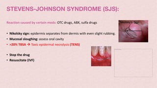 STEVENS-JOHNSON SYNDROME (SJS):
Reaction caused by certain meds: OTC drugs, ABX, sulfa drugs
• Nikolsky sign: epidermis separates from dermis with even slight rubbing.
• Mucosal sloughing: assess oral cavity
• >20% TBSA à Toxic epidermal necrolysis (TENS)
• Stop the drug
• Resuscitate (IVF)
The picture can't be displayed.
 