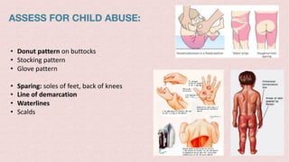 ASSESS FOR CHILD ABUSE:
• Donut pattern on buttocks
• Stocking pattern
• Glove pattern
• Sparing: soles of feet, back of knees
• Line of demarcation
• Waterlines
• Scalds
 