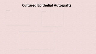 Cultured Epithelial Autografts
The picture can't be displayed.
The picture can't be displayed.
The picture can't be displayed.
 