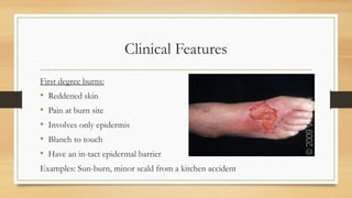 Clinical Features
First degree burns:
• Reddened skin
• Pain at burn site
• Involves only epidermis
• Blanch to touch
• Have an in-tact epidermal barrier
Examples: Sun-burn, minor scald from a kitchen accident
 