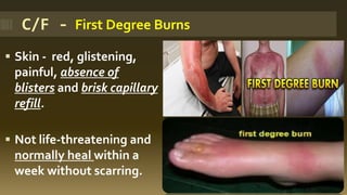 C/F - First Degree Burns
▪ Skin - red, glistening,
painful, absence of
blisters and brisk capillary
refill.
▪ Not life-threatening and
normally heal within a
week without scarring.
 
