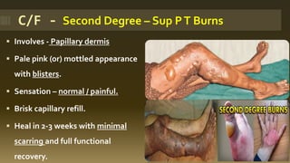 ▪ Involves - Papillary dermis
▪ Pale pink (or) mottled appearance
with blisters.
▪ Sensation – normal / painful.
▪ Brisk capillary refill.
▪ Heal in 2-3 weeks with minimal
scarring and full functional
recovery.
C/F - Second Degree – Sup PT Burns
 